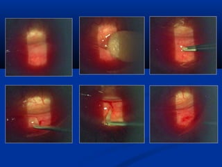 Surgery for Optometry