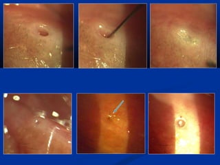 Surgery for Optometry