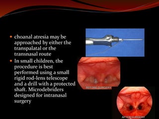  choanal atresia may be
approached by either the
transpalatal or the
transnasal route
 In small children, the
procedure is best
performed using a small
rigid rod-lens telescope
and a drill with a protected
shaft. Microdebriders
designed for intranasal
surgery
 