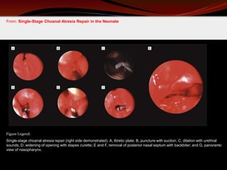 From: Single-Stage Choanal Atresia Repair in the Neonate
Single-stage choanal atresia repair (right side demonstrated). A, Atretic plate; B, puncture with suction; C, dilation with urethral
sounds; D, widening of opening with stapes curette; E and F, removal of posterior nasal septum with backbiter; and G, panoramic
view of nasopharynx.
Figure Legend:
 