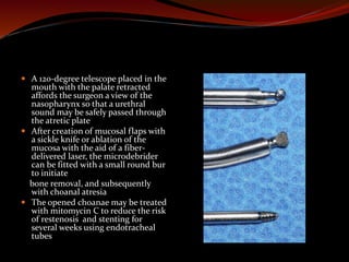  A 120-degree telescope placed in the
mouth with the palate retracted
affords the surgeon a view of the
nasopharynx so that a urethral
sound may be safely passed through
the atretic plate
 After creation of mucosal flaps with
a sickle knife or ablation of the
mucosa with the aid of a fiber-
delivered laser, the microdebrider
can be fitted with a small round bur
to initiate
bone removal, and subsequently
with choanal atresia
 The opened choanae may be treated
with mitomycin C to reduce the risk
of restenosis and stenting for
several weeks using endotracheal
tubes
 