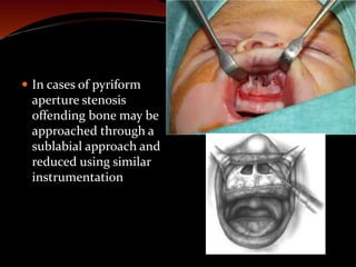  In cases of pyriform
aperture stenosis
offending bone may be
approached through a
sublabial approach and
reduced using similar
instrumentation
 