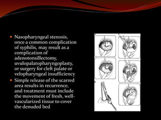  Nasopharyngeal stenosis,
once a common complication
of syphilis, may result as a
complication of
adenotonsillectomy,
uvulopalatopharyngoplasty,
or surgery for cleft palate or
velopharyngeal insufficiency
 Simple release of the scarred
area results in recurrence,
and treatment must include
the movement of fresh, well-
vascularized tissue to cover
the denuded bed
 