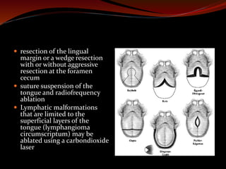  resection of the lingual
margin or a wedge resection
with or without aggressive
resection at the foramen
cecum
 suture suspension of the
tongue and radiofrequency
ablation
 Lymphatic malformations
that are limited to the
superficial layers of the
tongue (lymphangioma
circumscriptum) may be
ablated using a carbondioxide
laser
 