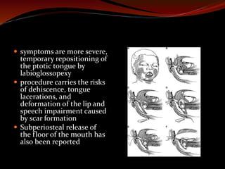  symptoms are more severe,
temporary repositioning of
the ptotic tongue by
labioglossopexy
 procedure carries the risks
of dehiscence, tongue
lacerations, and
deformation of the lip and
speech impairment caused
by scar formation
 Subperiosteal release of
the floor of the mouth has
also been reported
 