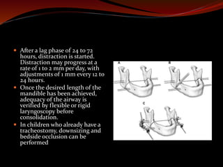  After a lag phase of 24 to 72
hours, distraction is started.
Distraction may progress at a
rate of 1 to 2 mm per day, with
adjustments of 1 mm every 12 to
24 hours.
 Once the desired length of the
mandible has been achieved,
adequacy of the airway is
verified by flexible or rigid
laryngoscopy before
consolidation.
 In children who already have a
tracheostomy, downsizing and
bedside occlusion can be
performed
 