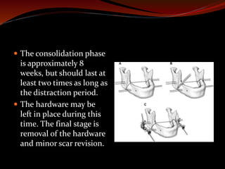  The consolidation phase
is approximately 8
weeks, but should last at
least two times as long as
the distraction period.
 The hardware may be
left in place during this
time. The final stage is
removal of the hardware
and minor scar revision.
 