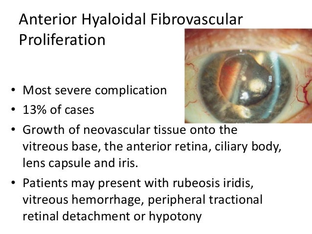 Surgery for proliferative diabetic retinopathy
