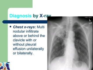 Diagnosis by X-ray 
 Chest x-rays: Multi 
nodular infiltrate 
above or behind the 
clavicle with or 
without pleural 
effusion unilaterally 
or bilaterally. 
10 
 