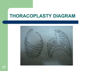 THORACOPLASTY DIAGRAM 
17 
 