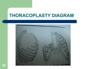 THORACOPLASTY DIAGRAM 
18 
 