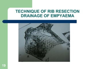 TECHNIQUE OF RIB RESECTION 
DRAINAGE OF EMPYAEMA 
19 
 