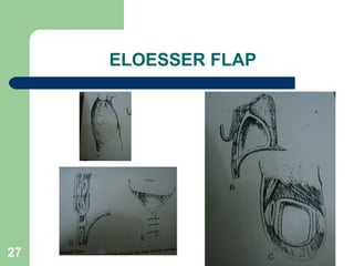 ELOESSER FLAP 
27 
 