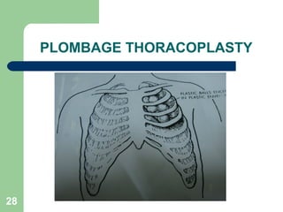 PLOMBAGE THORACOPLASTY 
28 
 
