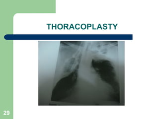THORACOPLASTY 
29 
 
