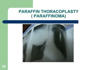 PARAFFIN THORACOPLASTY 
( PARAFFINOMA) 
30 
 