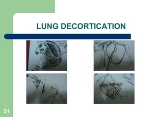 LUNG DECORTICATION 
31 
 