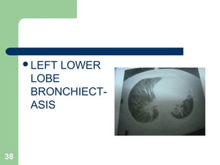 LEFT LOWER 
LOBE 
BRONCHIECT-ASIS 
38 
 