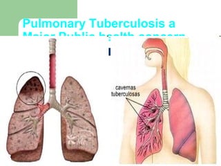 Pulmonary Tuberculosis a 
Major Public health concern 
8 
 