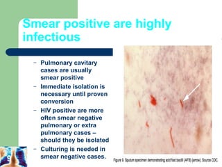 Smear positive are highly 
infectious 
– Pulmonary cavitary 
cases are usually 
smear positive 
– Immediate isolation is 
necessary until proven 
conversion 
– HIV positive are more 
often smear negative 
pulmonary or extra 
pulmonary cases – 
should they be isolated 
– Culturing is needed in 
9 smear negative cases. 
 