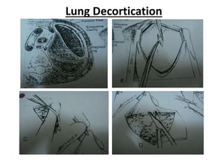 Surgery for tuberculosis of the chest 2019 | PPT