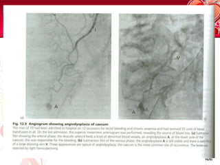 BLOOD TRANFUSIONINDICATION OF BLOOD TRANSFUSIONBLOOD TESTHaemoglobin - May be normal during the acute stages until haemodilution occursUrea and electrolytes - Elevated blood urea suggests severe bleedingCross match for transfusion - Two units of blood are sufficient unless bleeding is extreme.If the transfusion is not needed urgently, group the blood and save the serumLFT and coagulation profile1.Systolic BP < 110 mmHg2.Postural hypotension3.Pulse > 110/min4.Haemoglobin <8g/dl5.Angina or cardiovascular disease with a Haemoglobin <10g/dl48/81