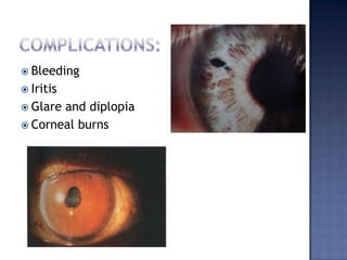 uveitis