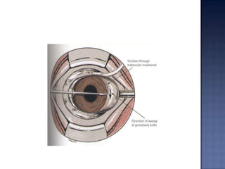 peripheral iridotomyDefinition:    -creating a full thickness hole in the peripheral iris in order to alleviate the pupillary block.