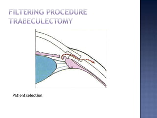 Narrow occludable angles