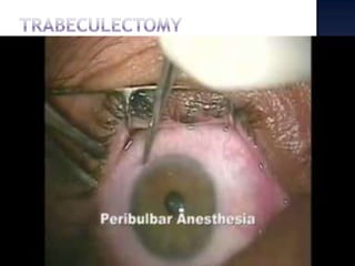 Narrow angle in POAG