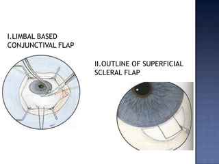 Combined mech glaucomaPeripheral iridotomy