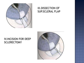 TECHNIQUE OF IRIDOTOMYPUPIL IS MIOSED PRE-OPSITE:PERIPHERY OF IRIS,SUPERIOR IRIS11-1 o clock position TO PREVENT THE IRRADIATION OF FOVEA.SUCCESSFUL IRIDOTOMY:GUSH OF PIGMENT DEBRIS