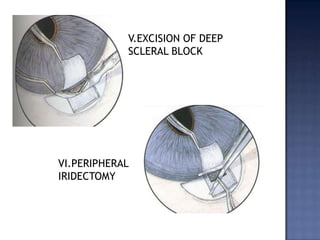 COMPLICATIONS:BleedingIritisGlare and diplopiaCorneal burns