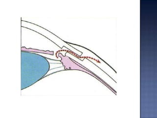 Surgery for congenital glaucomaGoniotomyTrabeculotomytrabeculectomy