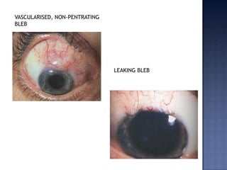 Pre-op care:Acetazolamide:one week before to clear corneal opacityARI & NLD obstruction – treatedComplications:Post-op hyphemaInjury to iris & lensDM detachment