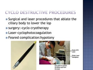 Iridectomy at this point