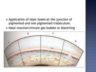 Pigmentation-pseudo exfoliation type;-pigmentary