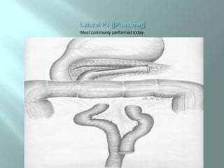 Most commonly performed today
 