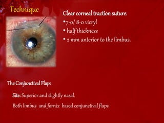 Technique Clear corneal traction suture: 
•7-0/ 8-0 vicryl 
• half thickness 
• 2 mm anterior to the limbus. 
The Conjunctival Flap: 
Site: Superior and slightly nasal. 
Both limbus and fornix based conjunctival flaps 
 