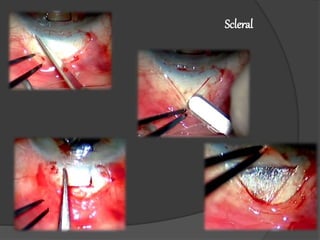 Scleral 
Flap 
 