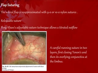 Flap Suturing 
The scleral flap is reapproximated with 9-0 or 10-0 nylon sutures . 
Releasable suture 
Peng Khaw’s adjustable suture technique allows a titrated outflow 
A careful running suture in two 
layers, first closing Tenon’s and 
then its overlying conjunctiva at 
the limbus. 
 