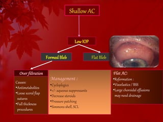Shallow AC 
Low IOP 
Formed Bleb Flat Bleb 
Over filtration 
Causes: 
•Antimetabolites 
•Loose sceral flap 
sutures 
•Full thickness 
procedures 
Management : 
•Cycloplegics 
•+/- aqueous suppressants 
•Decrease steroids 
•Pressure patching 
•Simmons shell, SCL 
Flat AC: 
•Reformation : 
•Visoelastics / BSS 
•Large choroidal effusions 
may need drainage 
 