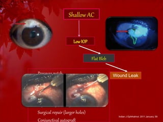 Shallow AC 
Low IOP 
Flat Bleb 
Pressure patch Wound Leak 
Temporary tapering of topical steroids 
Large diameter SCL 
Cyanoacrylate Glue 
Injection of autologous blood 
Surgical repair (larger holes) 
Conjunctival autograft 
Indian J Ophthalmol. 2011 January; 59 
 