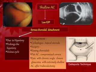 Shallow AC 
Low IOP 
Serous choroidal detachment 
•Due to Hypotony 
•Prolongs the 
hypotony 
•Vicious cycle 
Management : 
•Cycloplegics , topical steroids 
•Surgery : 
•Kissing choroidals 
•Flat AC , compromised cornea 
•Eyes with chronic angle closure 
glaucoma with extremely shallow 
AC, after trabeculectomy 
Dellaporta Technique 
 