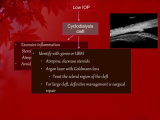 Low IOP 
CB Shutdown 
• Excessive inflammation 
Steroids 
Atropine 
Cyclodialysis 
cleft 
• Identify with gonio or UBM 
• Atropine, decrease steroids 
• Argon laser with Goldmann lens 
• Avoid beta blockers, CAI inhibitors 
• Treat the scleral region of the cleft 
• For large cleft, definitive management is surgical 
repair 
 