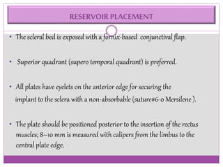 RESERVOIR PLACEMENT 
• The scleral bed is exposed with a fornix-based conjunctival flap. 
• Superior quadrant (supero temporal quadrant) is preferred. 
• All plates have eyelets on the anterior edge for securing the 
implant to the sclera with a non-absorbable (suture#6-0 Mersilene ). 
• The plate should be positioned posterior to the insertion of the rectus 
muscles; 8–10 mm is measured with calipers from the limbus to the 
central plate edge. 
 