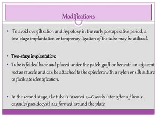 Modifications 
• To avoid overfiltration and hypotony in the early postoperative period, a 
two-stage implantation or temporary ligation of the tube may be utilized. 
• Two-stage implantation: 
• Tube is folded back and placed under the patch graft or beneath an adjacent 
rectus muscle and can be attached to the episclera with a nylon or silk suture 
to facilitate identification. 
• In the second stage, the tube is inserted 4–6 weeks later after a fibrous 
capsule (pseudocyst) has formed around the plate. 
 