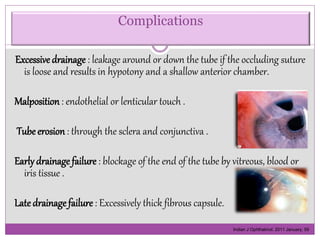 Complications 
Excessive drainage : leakage around or down the tube if the occluding suture 
is loose and results in hypotony and a shallow anterior chamber. 
Malposition : endothelial or lenticular touch . 
Tube erosion : through the sclera and conjunctiva . 
Early drainage failure : blockage of the end of the tube by vitreous, blood or 
iris tissue . 
Late drainage failure : Excessively thick fibrous capsule. 
Indian J Ophthalmol. 2011 January; 59 
 