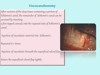 Viscocanalostomy 
After excision of the deep tissue containing a portion of 
Schlemm’s canal, the remainder of Schlemm’s canal can be 
accessed by inserting 
a fine-tipped cannula into the exposed ostia of Schlemm’s 
canal. 
Injection of viscoelastic material into Schlemm’s . 
Repeated 6-7 times. 
Injection of viscoelastic beneath the superficial scleral flap. 
Suture the superficial scleral flap tightly. 
 