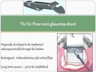 The Ex-Press mini glaucoma shunt 
Originally developed to be implanted 
subconjunctivally through the limbus 
Redesigned - trabeculectomy style scleral flap. 
Long term success – yet to be established. 
 